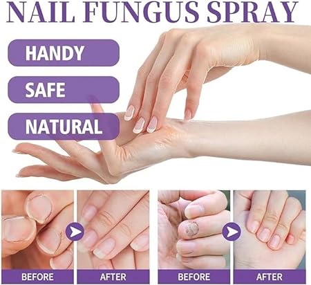 Nail Treatment for Toenails